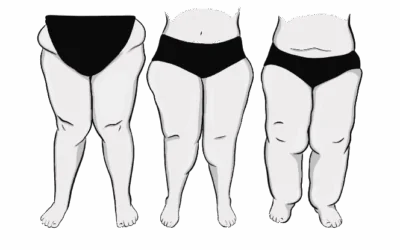 Lipedema: che cos’è e come trattarlo?